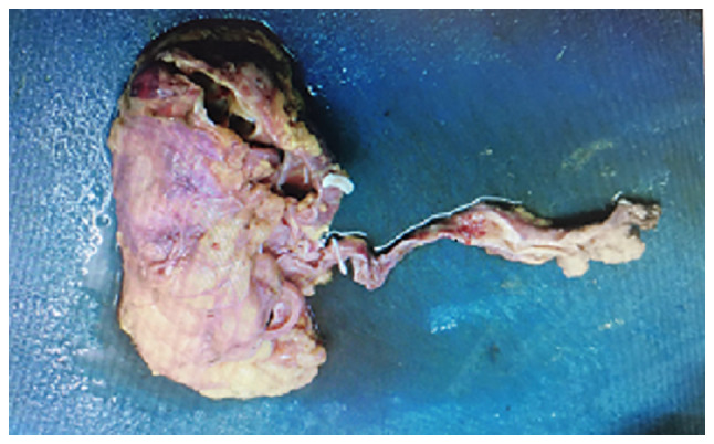 Chromophobe renal cell carcinoma with ipsilateral ureteral urothelial carcinoma: A case report.