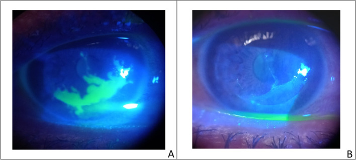 Epidemiological profile of microbial keratitis in Alexandria-Egypt a 5 years retrospective study.