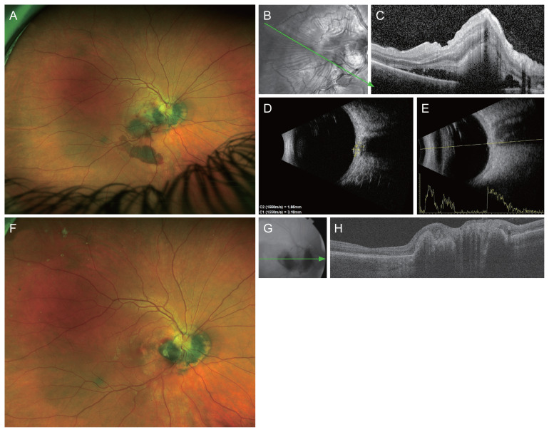 An Atypical Presentation of Optic Disc Melanocytoma: A Case Report.