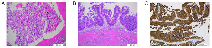 Chromophobe renal cell carcinoma with ipsilateral ureteral urothelial carcinoma: A case report.