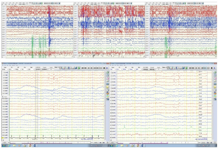 Presentation of Dyke-Davidoff-Masson Syndrome in adult male.