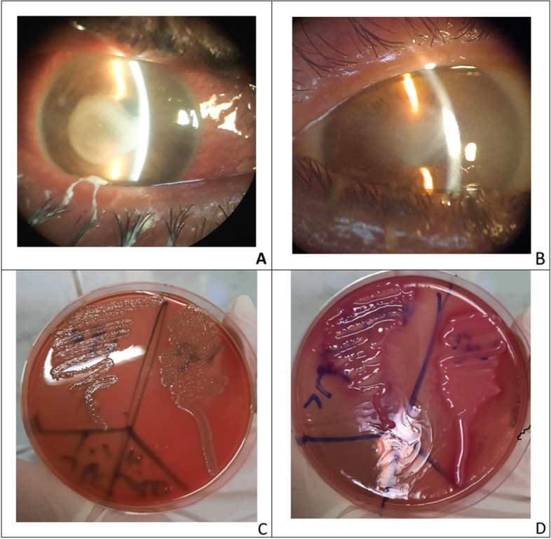 Epidemiological profile of microbial keratitis in Alexandria-Egypt a 5 years retrospective study.