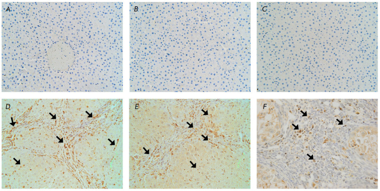 literammp-9 mRNA Expression and Bridging Fibrosis Progression in Toxic Liver Injury.