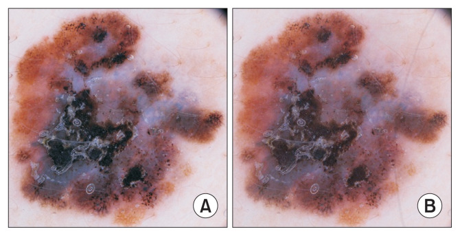 Design of a Machine Learning System to Predict the Thickness of a Melanoma Lesion in a Non-Invasive Way from Dermoscopic Images.