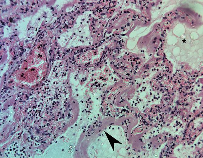 Histopathological autopsy findings in lungs of pregnant and postpartum women who died of COVID-19 infections.