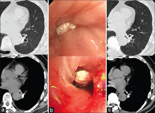 A 75-year-old man with transbronchial broncholithiasis followed up for 9 years!