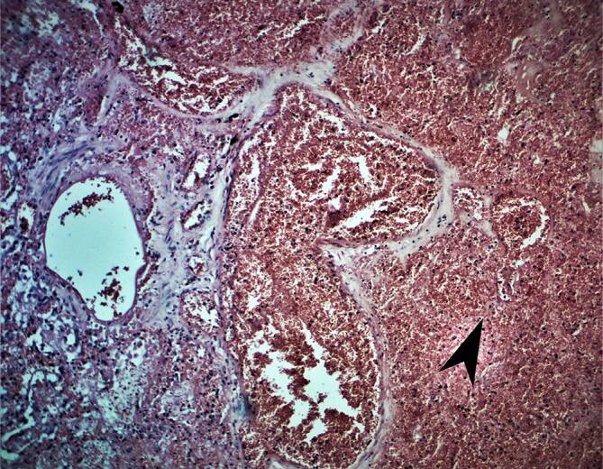 Histopathological autopsy findings in lungs of pregnant and postpartum women who died of COVID-19 infections.