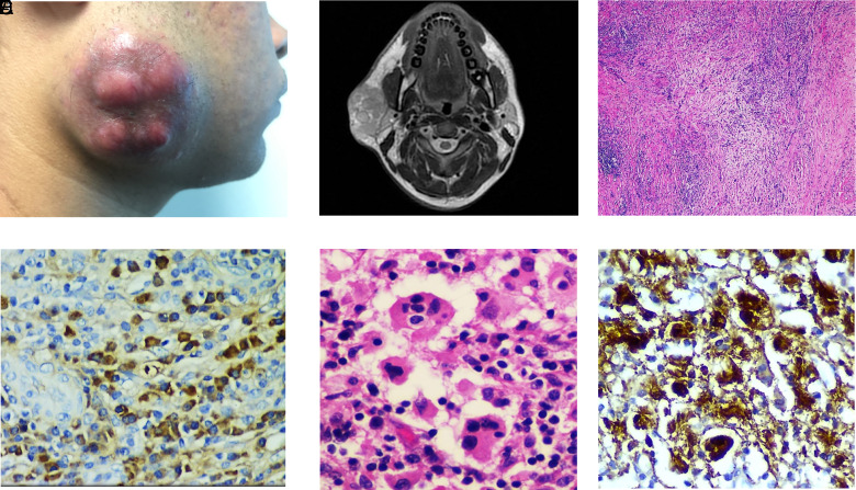 Immunoglobulin G4-Associated Rosai-Dorfman Disease: Report of 3 Cases.