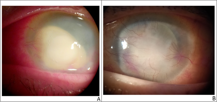 Epidemiological profile of microbial keratitis in Alexandria-Egypt a 5 years retrospective study.