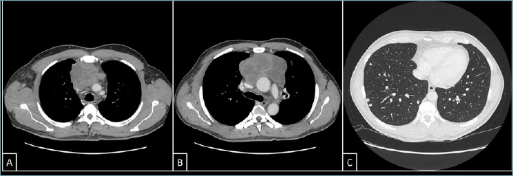 CIC-rearranged sarcoma presenting with superior vena cava syndrome: case report.