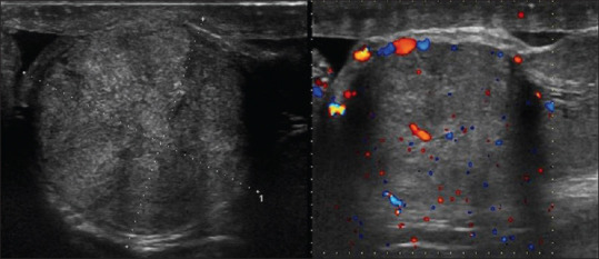 Adenomatoid Tumor of Epididymis Associated with Tubular Ectasia of Rete Testis: Sonographic Evaluation.