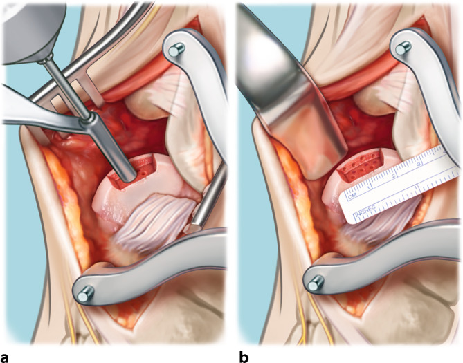 Talar OsteoPeriostic grafting from the Iliac Crest (TOPIC) for lateral osteochondral lesions of the talus: operative technique.