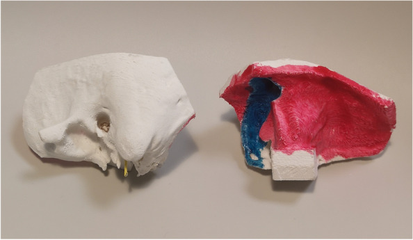 3D-printing a cost-effective model for mastoidectomy training.