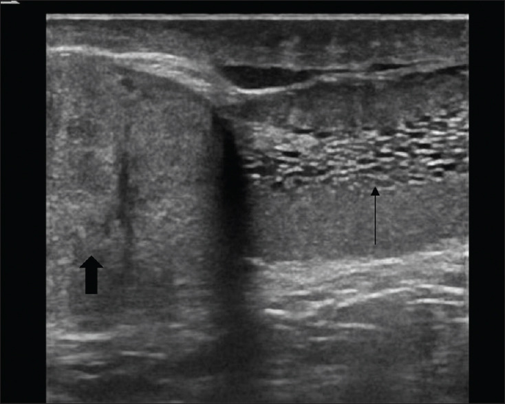 Adenomatoid Tumor of Epididymis Associated with Tubular Ectasia of Rete Testis: Sonographic Evaluation.