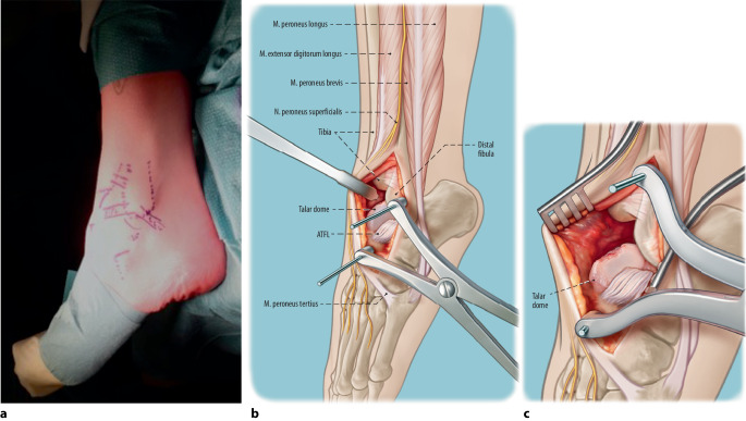 Talar OsteoPeriostic grafting from the Iliac Crest (TOPIC) for lateral osteochondral lesions of the talus: operative technique.