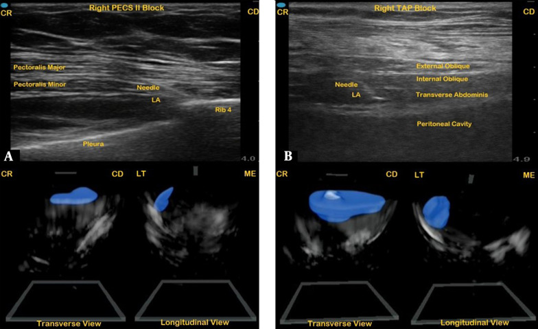 Three-Dimensional Imaging of Commonly Performed Peripheral Blocks: Using a Handheld Point-of-Care Ultrasound System.