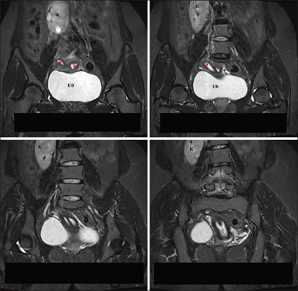 A 34-Year-Old Female with Recurrent Abortions.