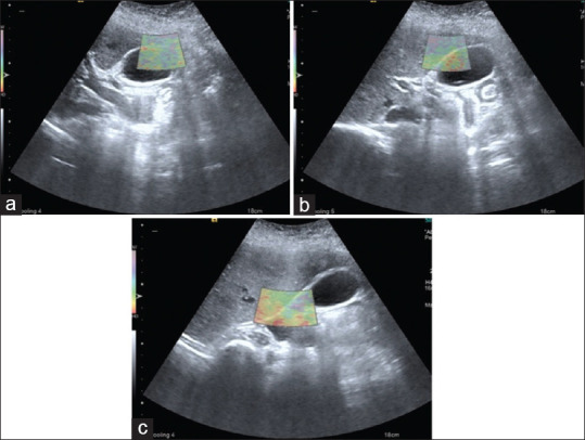 Adhesions Detection and Staging Classification for Preoperative Assessment of Difficult Laparoscopic Cholecystectomies: A Prospective Case-Control Study.