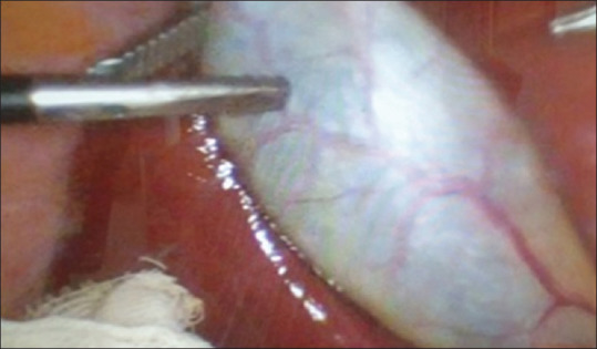 Adhesions Detection and Staging Classification for Preoperative Assessment of Difficult Laparoscopic Cholecystectomies: A Prospective Case-Control Study.