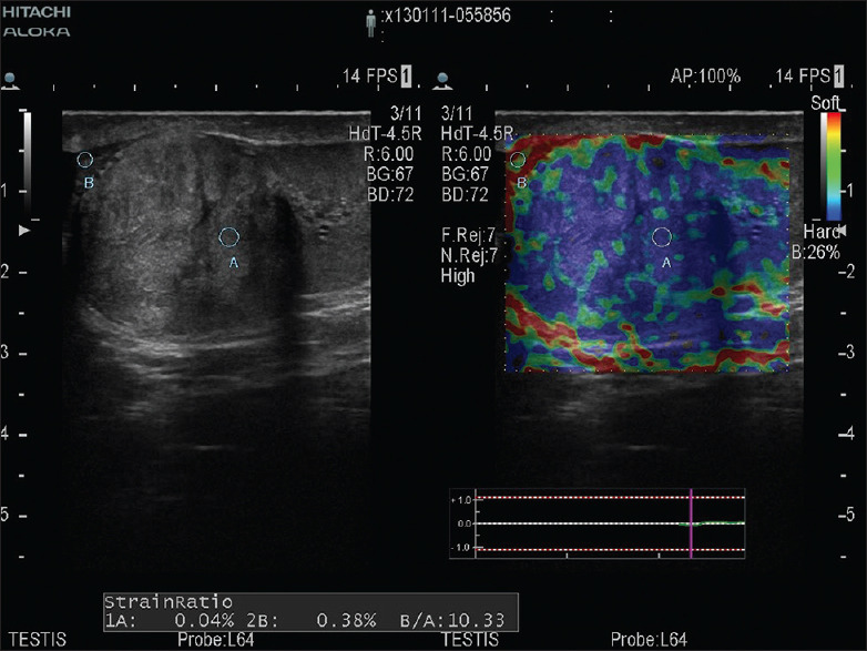 Adenomatoid Tumor of Epididymis Associated with Tubular Ectasia of Rete Testis: Sonographic Evaluation.