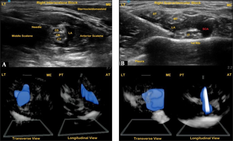 Three-Dimensional Imaging of Commonly Performed Peripheral Blocks: Using a Handheld Point-of-Care Ultrasound System.