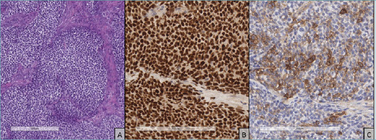 CIC-rearranged sarcoma presenting with superior vena cava syndrome: case report.