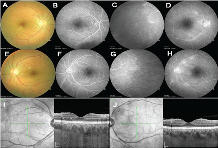 Different Cases, Different Manifestations of Post-COVID-19 Retinal Artery Occlusion: A Case Series.