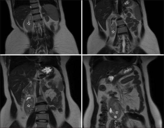 A 34-Year-Old Female with Recurrent Abortions.