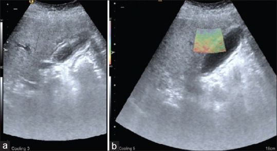 Adhesions Detection and Staging Classification for Preoperative Assessment of Difficult Laparoscopic Cholecystectomies: A Prospective Case-Control Study.