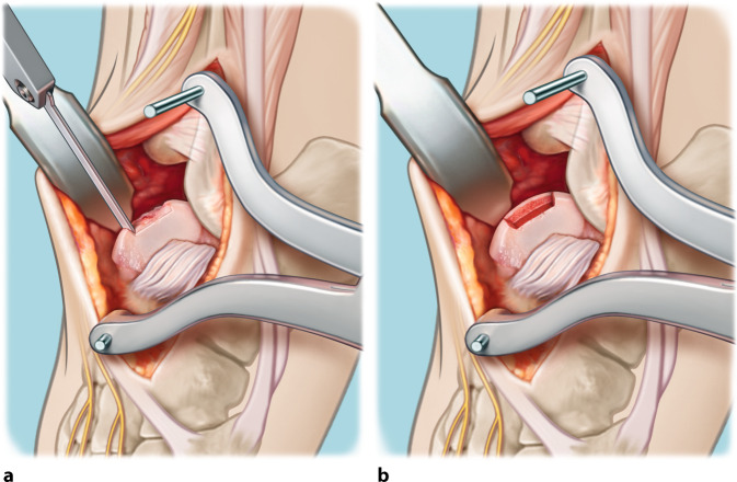 Talar OsteoPeriostic grafting from the Iliac Crest (TOPIC) for lateral osteochondral lesions of the talus: operative technique.