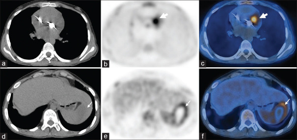 Utility of <sup>18</sup>F-Fluorodeoxyglucose Positron Emission Tomography/Computed Tomography in Cardiac Infections.