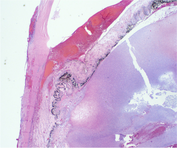 MRSA panophthalmitis in a brittle diabetic.