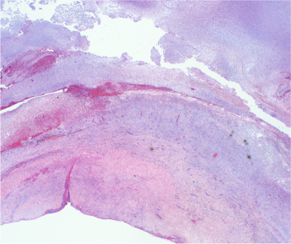 MRSA panophthalmitis in a brittle diabetic.