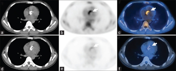 Utility of <sup>18</sup>F-Fluorodeoxyglucose Positron Emission Tomography/Computed Tomography in Cardiac Infections.