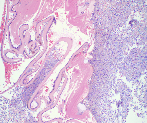 MRSA panophthalmitis in a brittle diabetic.