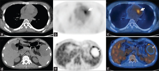 Utility of <sup>18</sup>F-Fluorodeoxyglucose Positron Emission Tomography/Computed Tomography in Cardiac Infections.