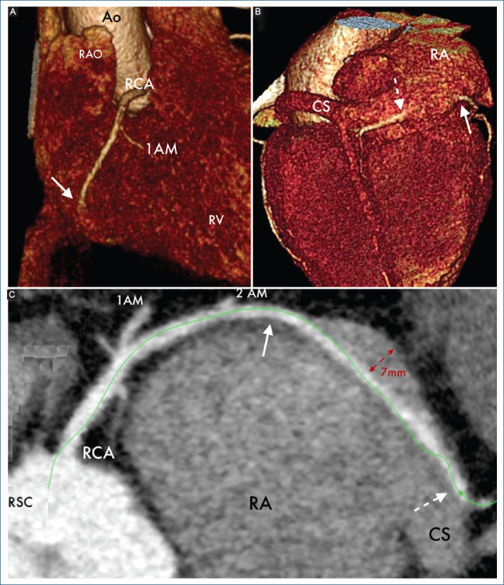 [Right coronary artery, a rare and risky course].