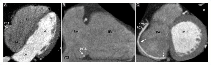 [Right coronary artery, a rare and risky course].