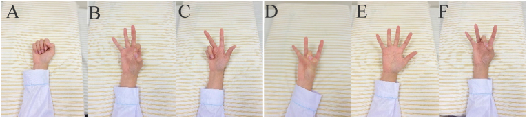 Comparison of the effects of three kinds of hand exercises on improving limb function in patients after transradial cardiac catheterization