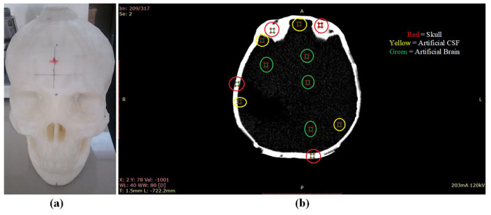 Evaluation of 3D Printed Anthropomorphic Head Phantom for Calibration of TLD in Eye Lens Dosimeter.