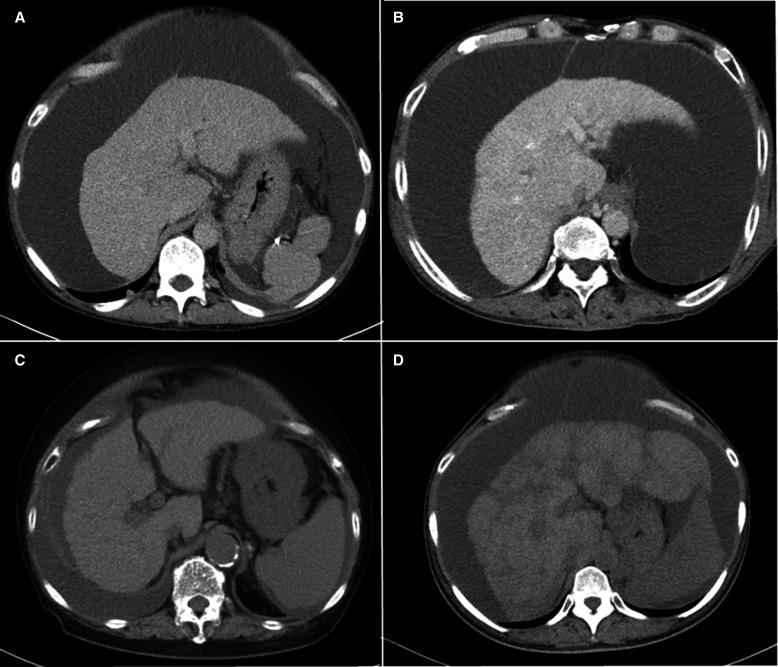 First reports of clinical effects of transjugular intrahepatic portosystemic shunt in four patients with cirrhotic ascites refractory to tolvaptan.