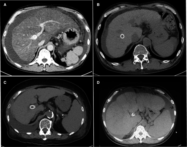 First reports of clinical effects of transjugular intrahepatic portosystemic shunt in four patients with cirrhotic ascites refractory to tolvaptan.