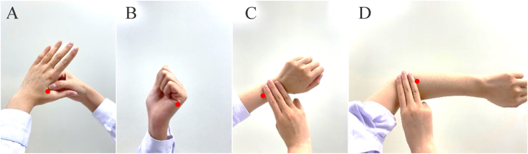 Comparison of the effects of three kinds of hand exercises on improving limb function in patients after transradial cardiac catheterization