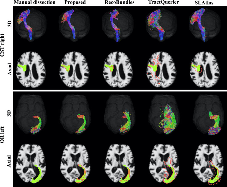 Automated three-dimensional major white matter bundle segmentation using diffusion magnetic resonance imaging