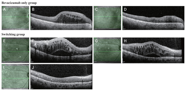 Comparison of Optical Coherence Tomography Biomarkers between Bevacizumab Good Responders and Nonresponders Who were Switched to Dexamethasone Implant in Diabetic Macular Edema.