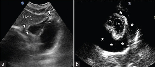 Focused Assessment with Sonography for Trauma (FAST).