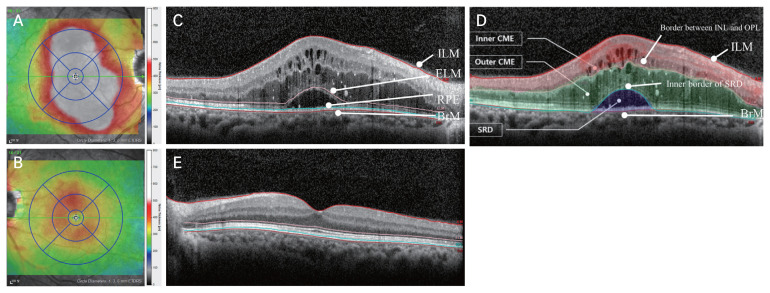 Comparison of Optical Coherence Tomography Biomarkers between Bevacizumab Good Responders and Nonresponders Who were Switched to Dexamethasone Implant in Diabetic Macular Edema.