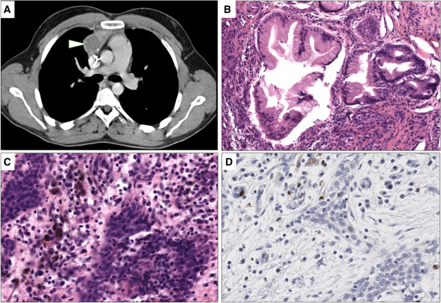 Genomic profiling of a metastatic anaplastic melanocytic neuroectodermal tumor arising from a mature thymic teratoma as part of a mediastinal germ cell tumor.