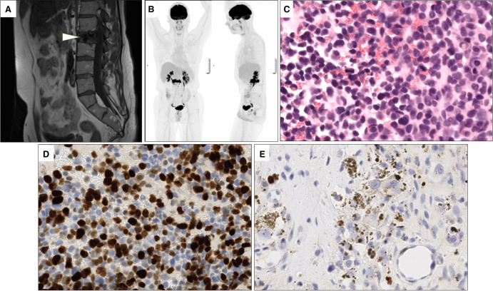 Genomic profiling of a metastatic anaplastic melanocytic neuroectodermal tumor arising from a mature thymic teratoma as part of a mediastinal germ cell tumor.