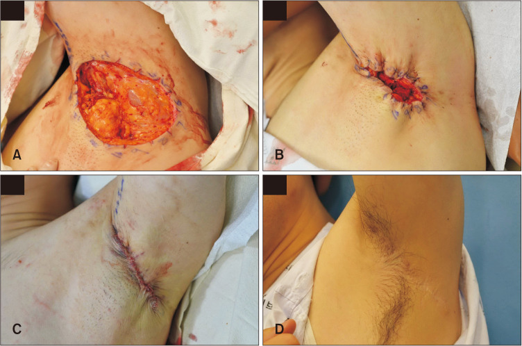 Various Applications of Purse-String Suture and Its Cosmetic Outcome in Cutaneous Surgical Defects.